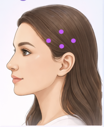 Diagram of trigger point injection sites in upper back and shoulder muscles
